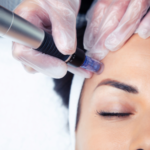 Facial Revitalization Microneedling with Hyaluronic Acid, Peptides & Salmon PDRN